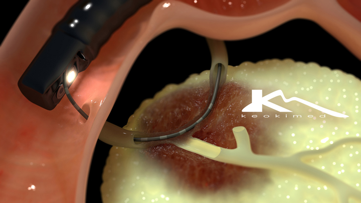 Ercp Endoscopic Retrograde Cholangio Pancreatography Keokimed